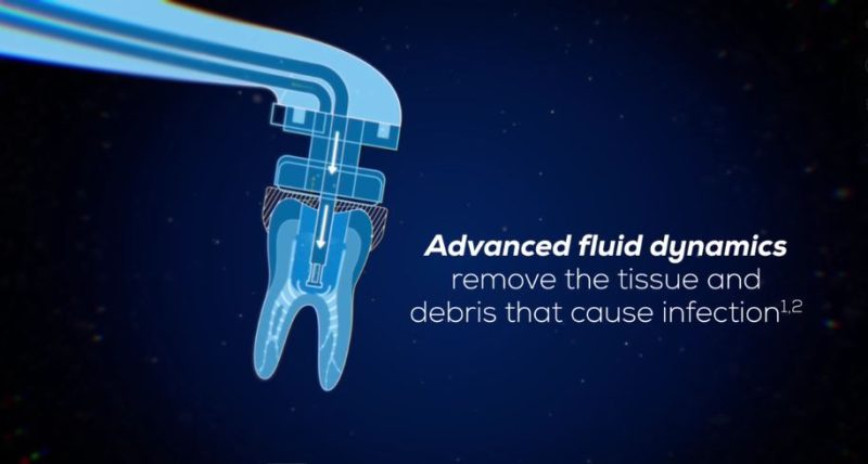 Illustration of Gentlewave system removing tissue and debris 